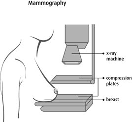 Illustration of mammography